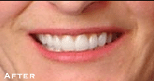 Stained, Chipped Smile - After