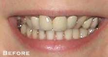 Multiple Spaces Between Teeth - Before