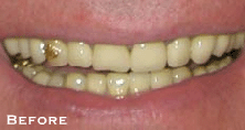 Small & Misshaped Teeth - Before