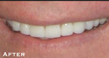Small & Misshaped Teeth - After