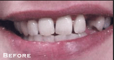 Small & Misshaped Teeth - Before