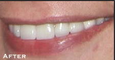Small & Misshaped Teeth - After