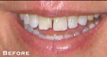 Tetracycline Stains/20 Year Recall Before