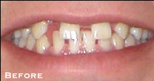 Stained, Crooked Teeth Before
