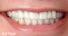 Stained, Crooked Teeth After