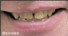 Spaced Teeth Before