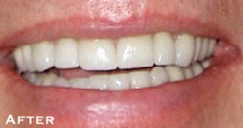 Spaced Teeth After