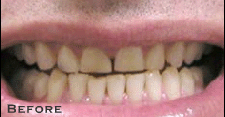 Straightening Crooked Teeth - Before
