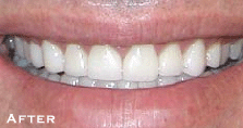 Straightening Crooked Teeth - After