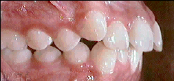 Dental crowding example image.
