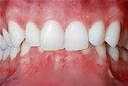Deep bite example image.