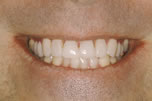 Straightening Crooked Teeth - After