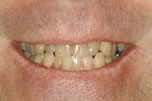 Straightening Crooked Teeth - Before