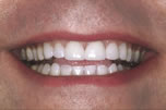 Multiple Spaces Between Teeth - After