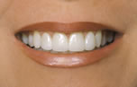 Stained, Chipped Smile - After