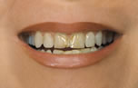 Stained, Chipped Smile - Before